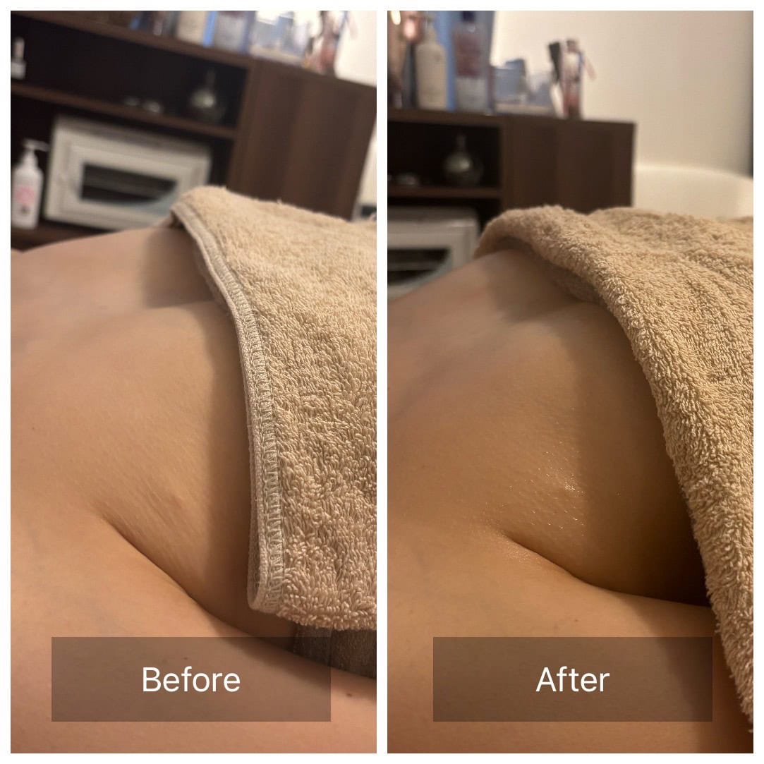 美容施術③バストケア