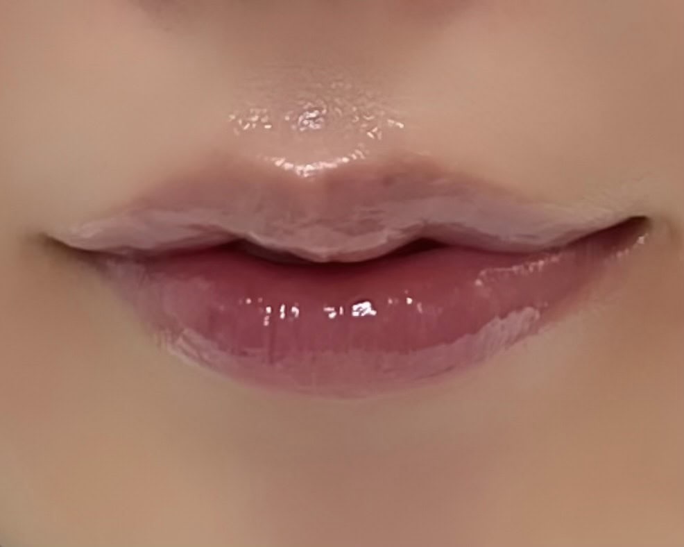 美容施術②唇ヒアルロン酸＆口角ボトックス