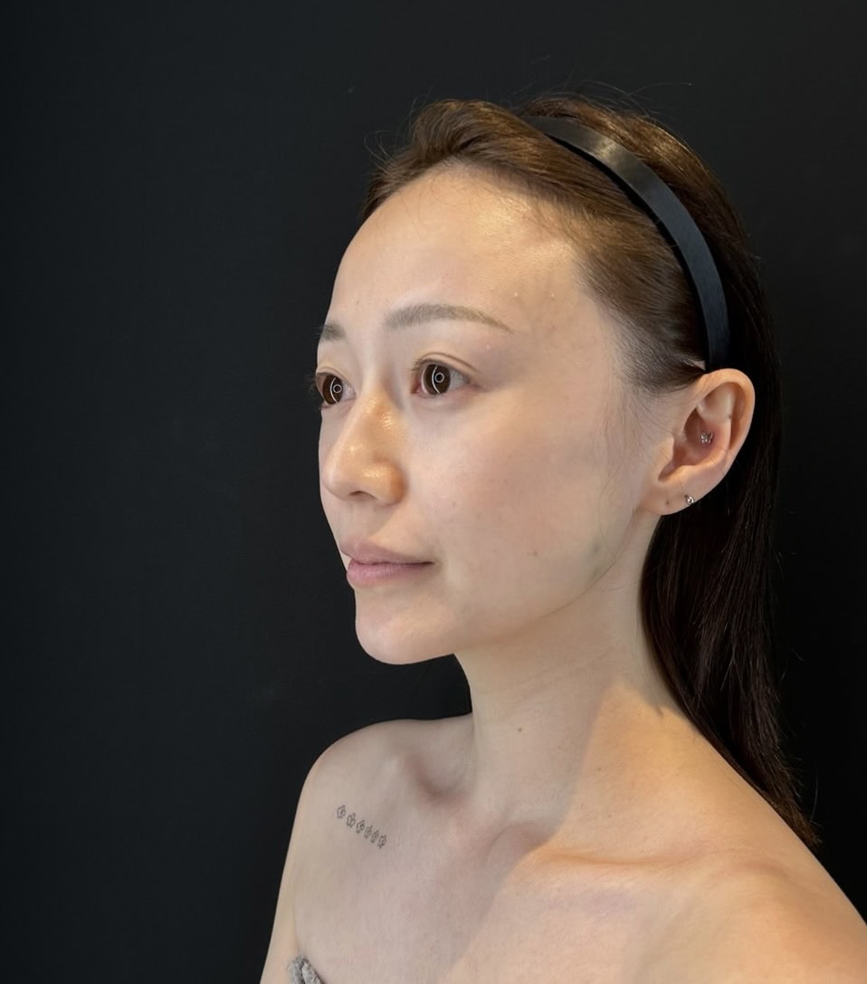 harukaさんの脂肪注入前の写真。頬とこめかみの凹みが目立って全体的に骨感があるのが気になる