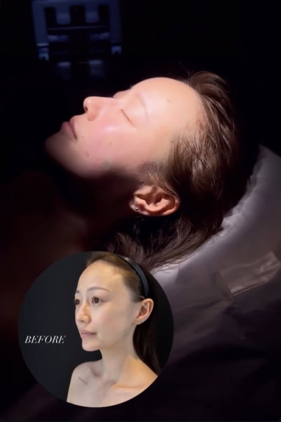 【美容医療】全顔脂肪注入から1年後のリアル。持続期間や定着率は？ダウンタイムの経過を時系列で徹底レビュー【sweet lovers】