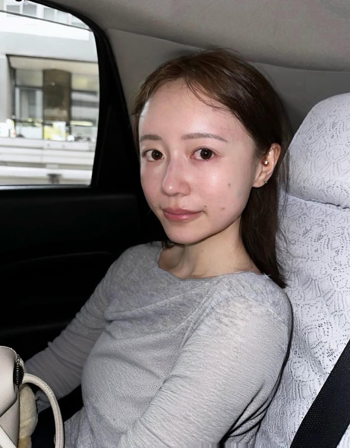 脂肪注入直後の写真。脂肪を取った脚は痛むけれど、すでにバブみを感じてテンション上がっているharukaさん