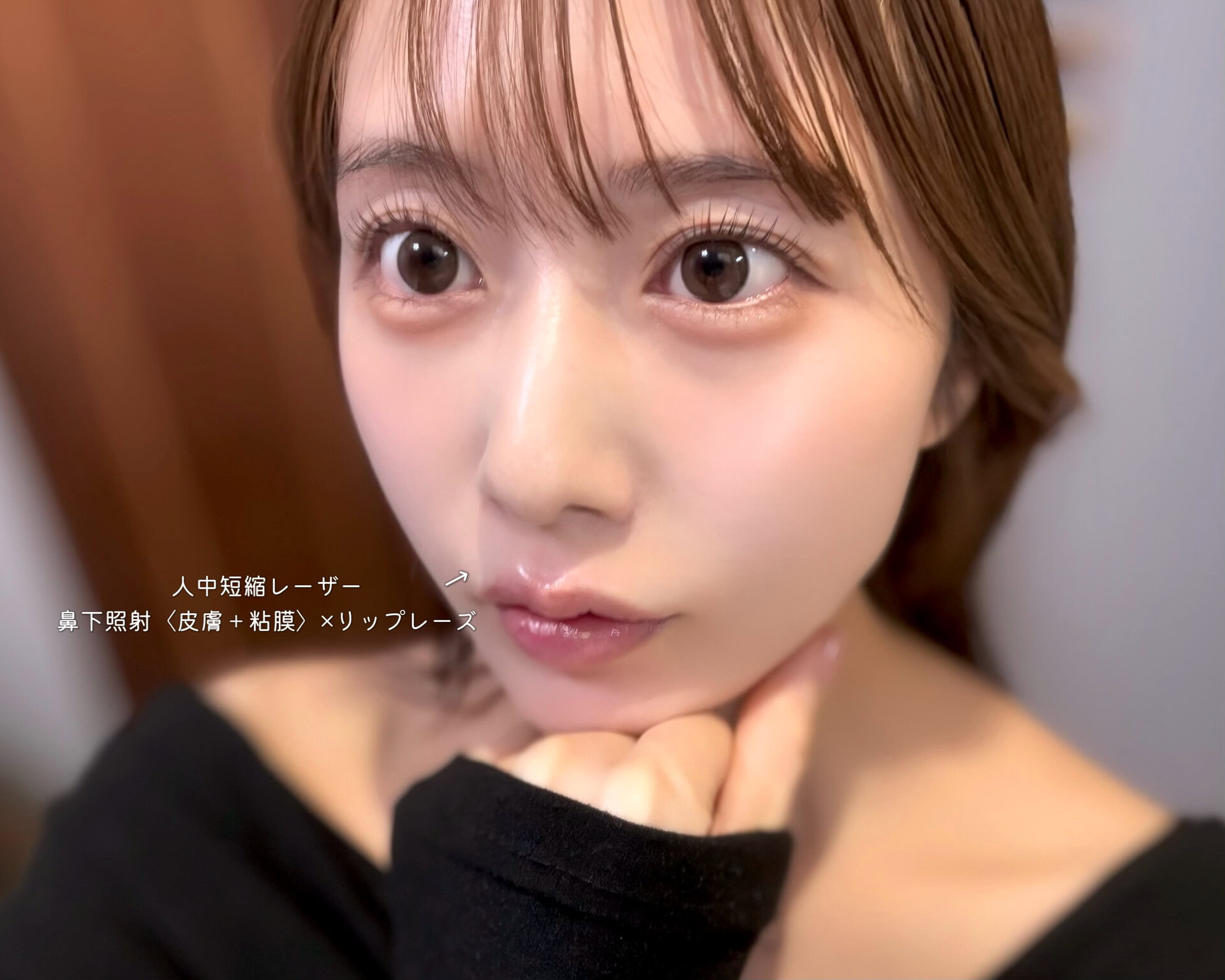 美容施術 人中短縮レーザー
